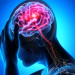 سن سکته مغزی در ایران کاهش یافت