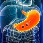 پیشرفت چشمگیر در تشخیص زودهنگام سرطان معده با استفاده از هوش مصنوعی